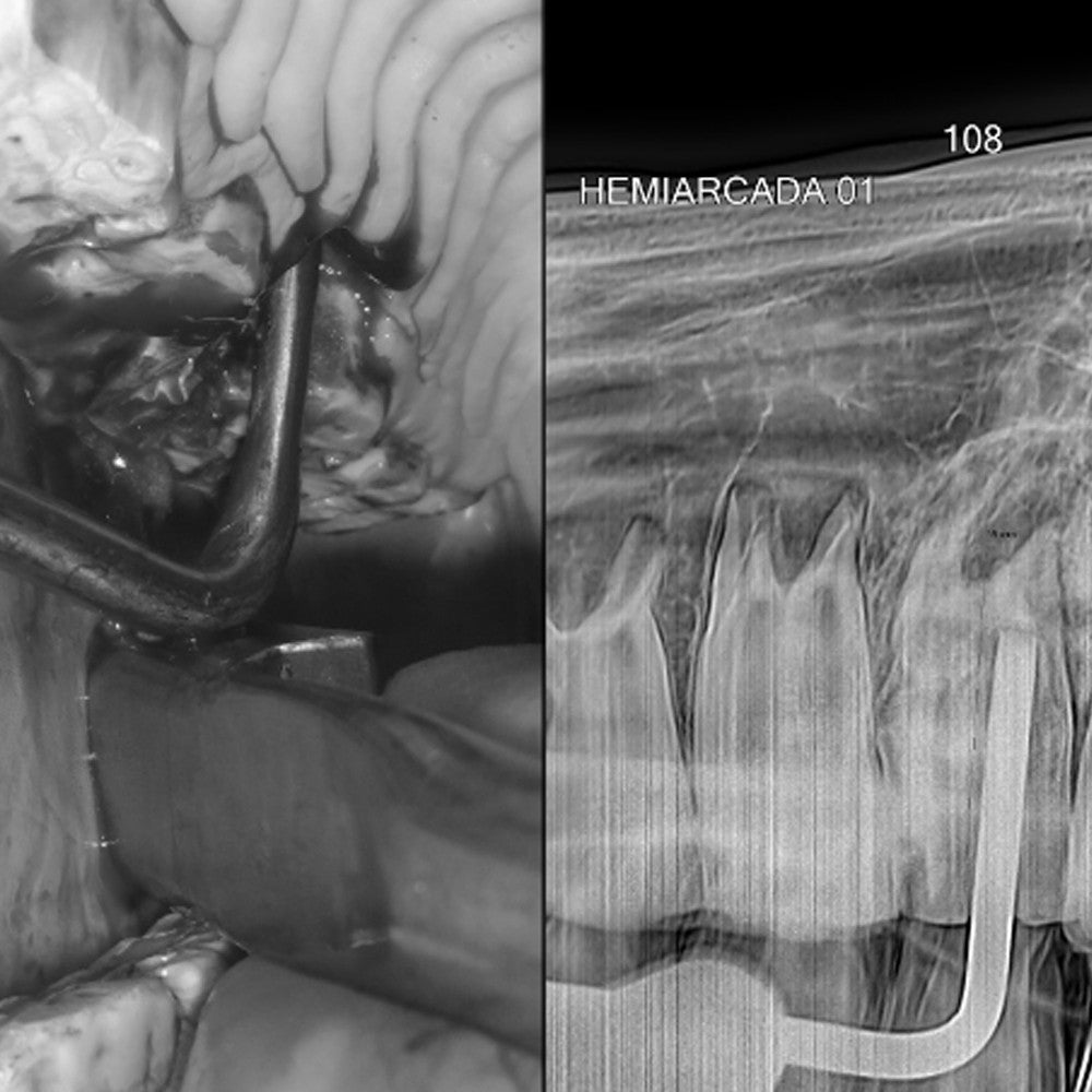 Set of BT Syndesmotomes/Elevators